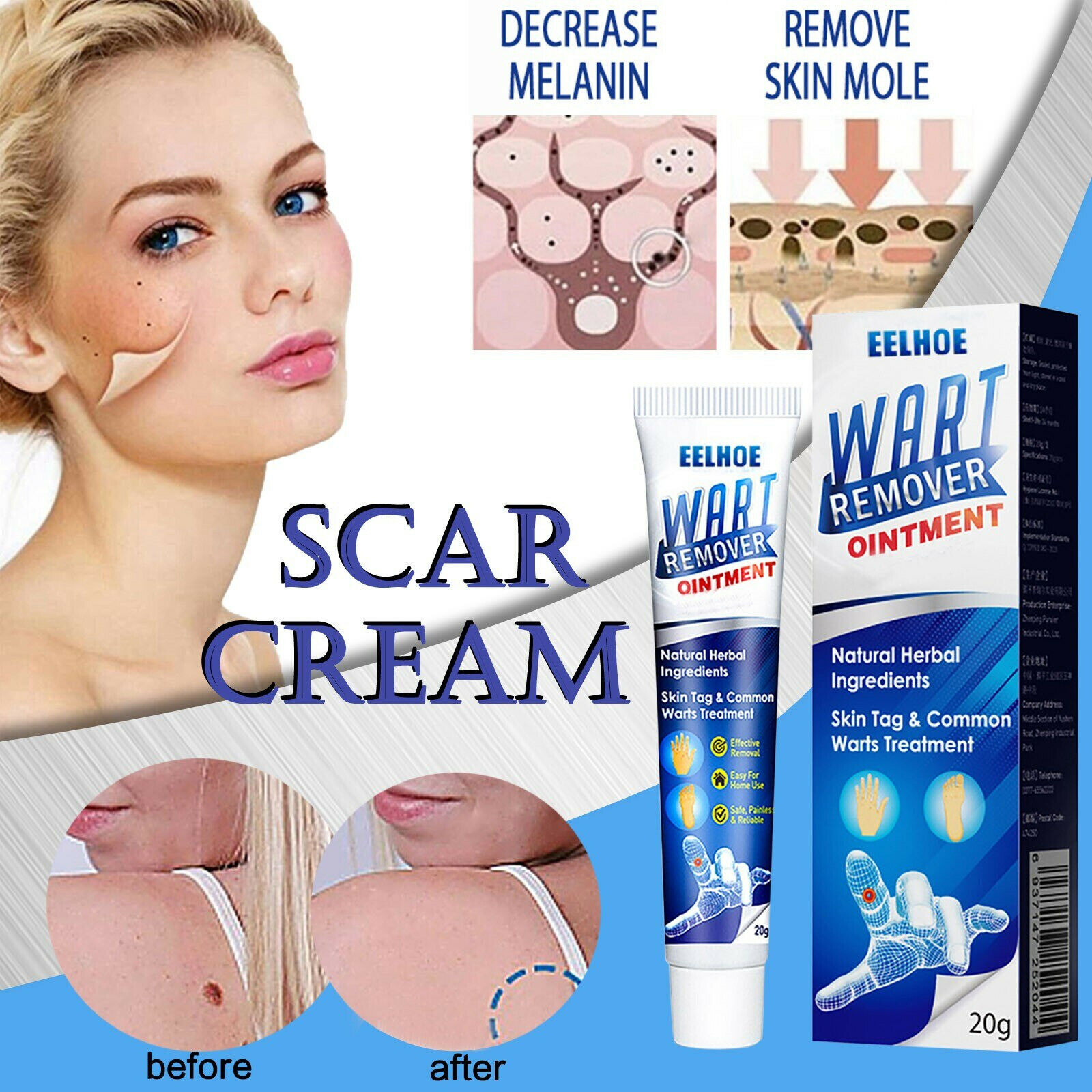 Wart Removal Treatment Cream Plantar Flat Filiform Periungual Common ...